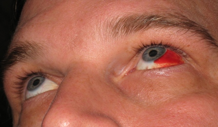 Blood Vessel Eye